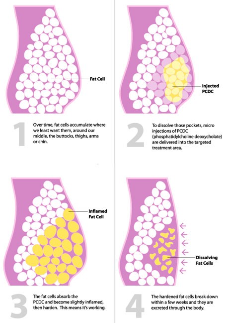 How Does Lipodissolve Work