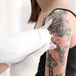 does laser tattoo removal hurt