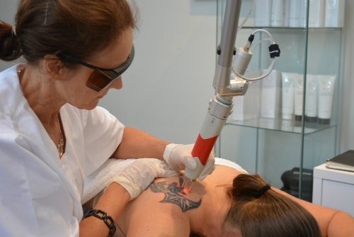 Renude Laser Tattoo Removal