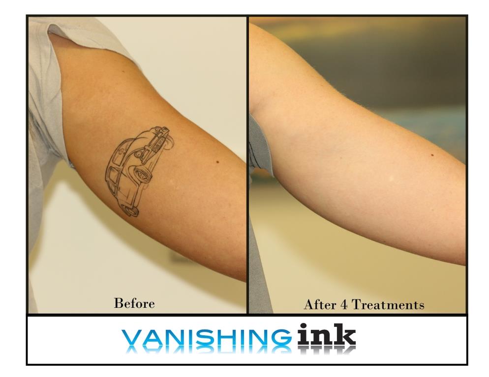 Vanishing Ink Tattoo Removal Clinic Review Ratings & Information
