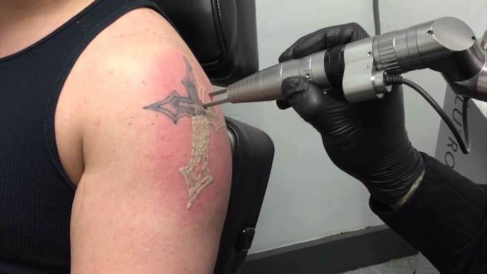 Lose Your Ink Laser Tattoo Removal